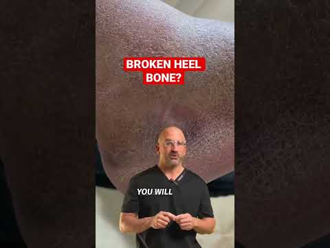 Voted “Most Painful” Bone Fracture #shorts